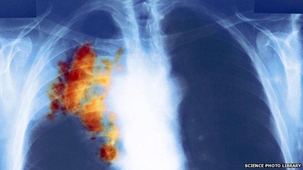 Coloured X-ray of the chest of a patient with small cell lung cancer