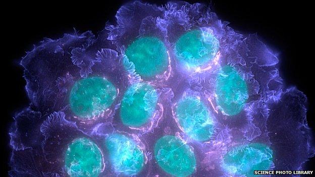 Breast cancer