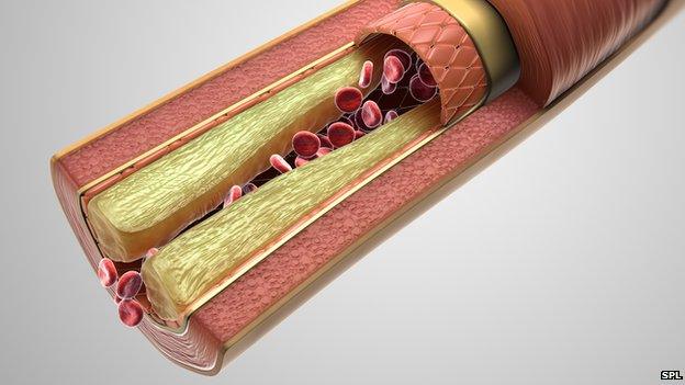 Cross section of an artery