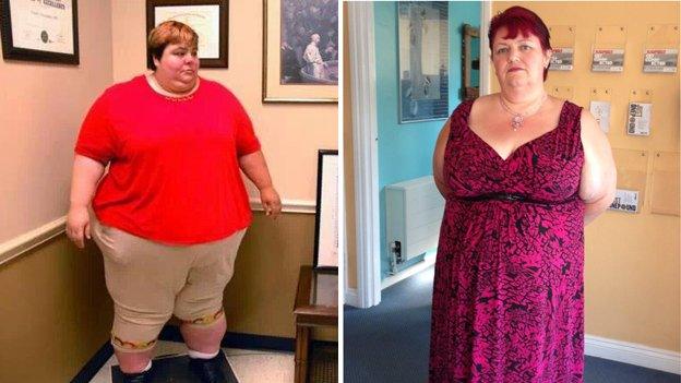 Zaneta Jones before and after she had weight-loss surgery