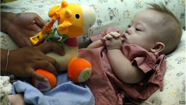 A Thai surrogate mother, Pattharamon Chanbua (not seen), 21, plays with her seven-month-old Down's Syndrome baby, Gammy at a hospital in Chonburi province, Thailand, 4 August 2014.