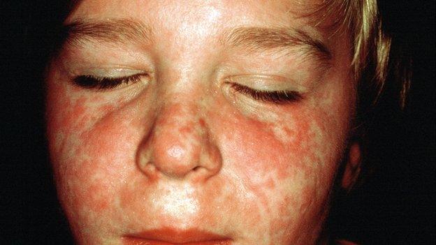 Boy with measles rash