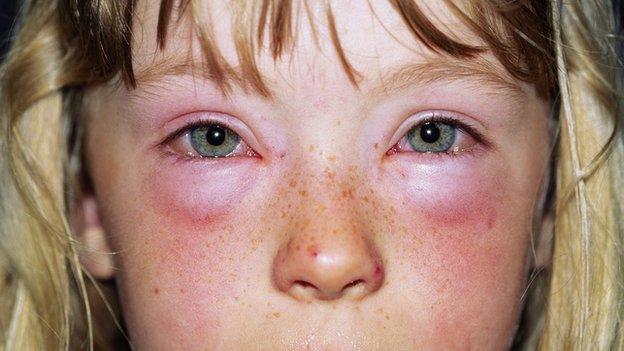 Child with unknown allergy