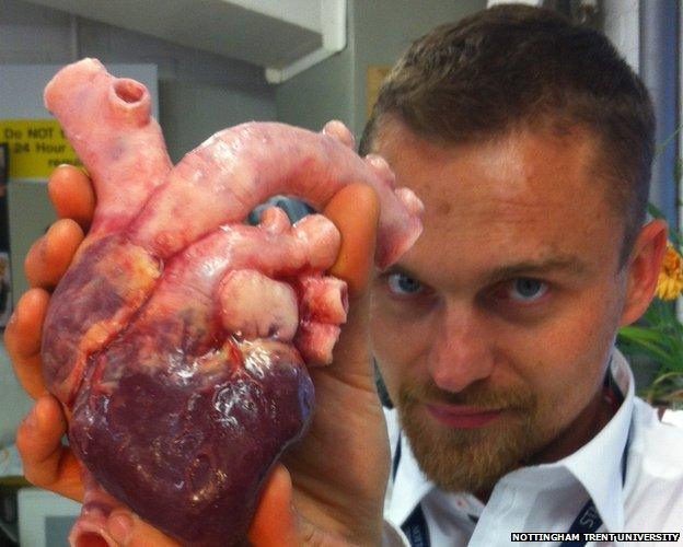 Richard Arm, prosthetic heart