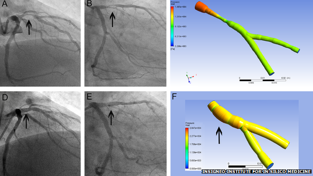 A coronary artery