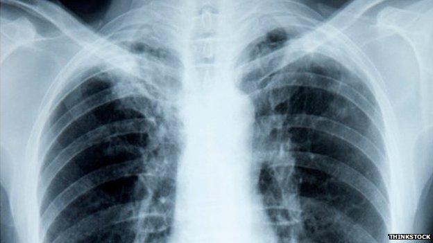 Chest X-ray