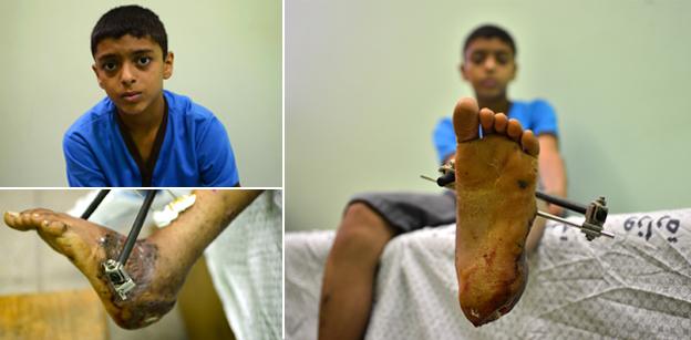 Ahmad, 13, shows his fractured foot