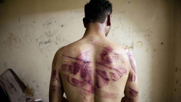 Syrian victim of torture