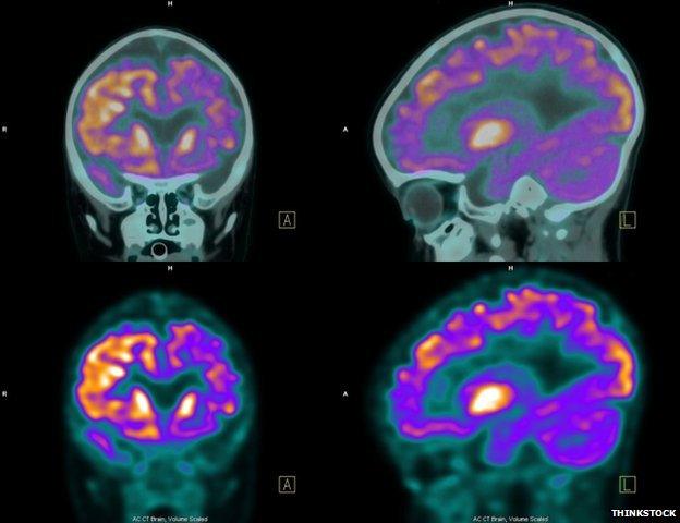 PET (positron emission tomography) scan of the brain