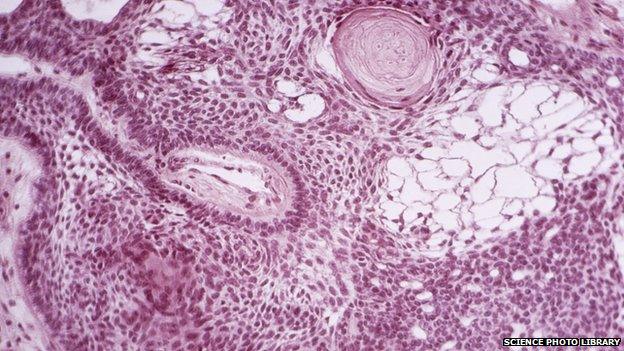 A brain tumour