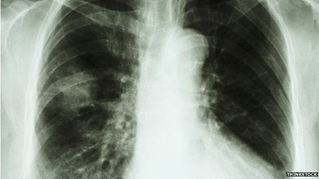 Chest x-ray