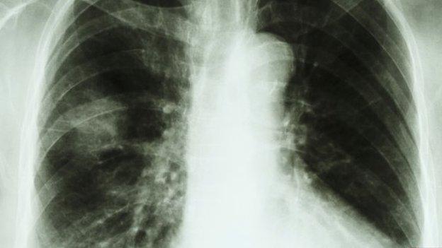 Chest x-ray