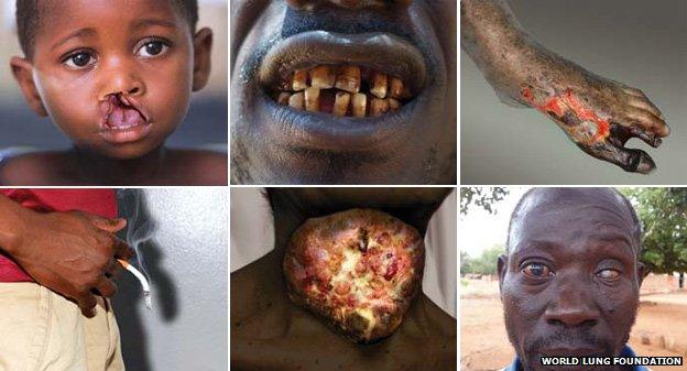 Six graphic images showing the dangers of smoking