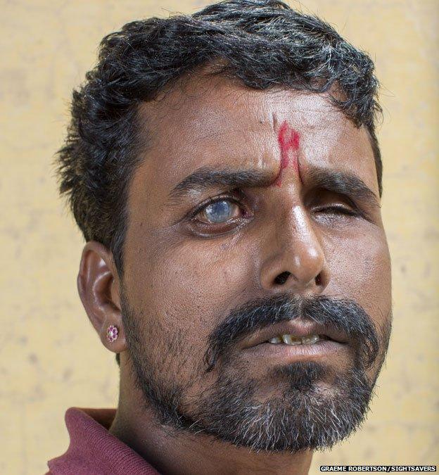 Shyam headshot. You can clearly see his right eye is damaged by cataracts.