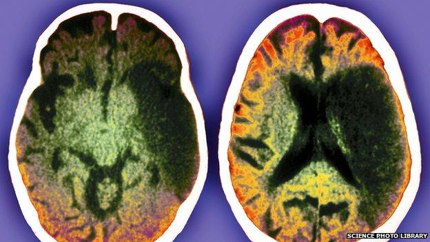 CT scans of a stroke patient's brain