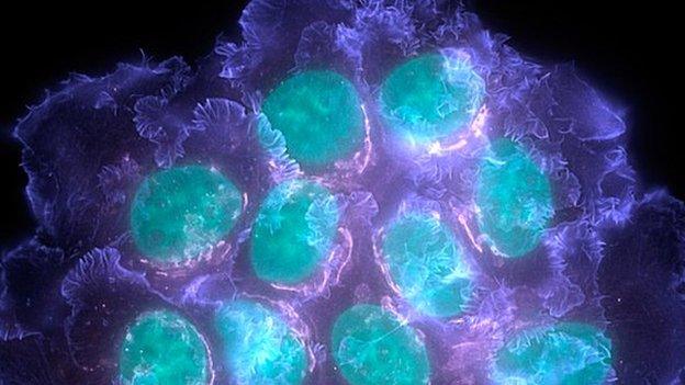 Breast cancer cells