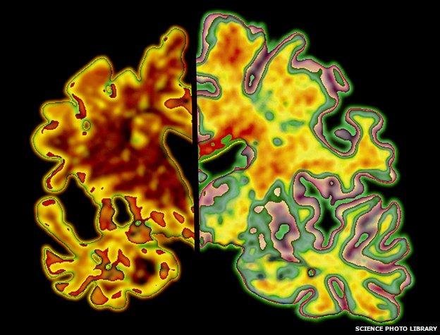 Computer graphic of a vertical (coronal) slice through the brain of an Alzheimer patient (at left) compared with a normal brain (at right).