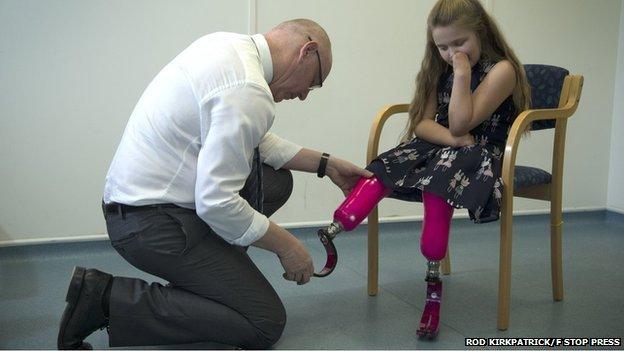 Grace having legs fitted