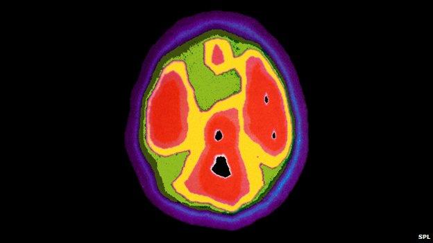 Brain scan of four-year-old with autism