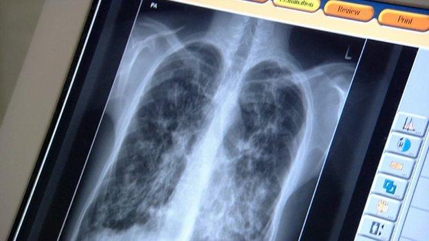 X-ray of patient's lungs