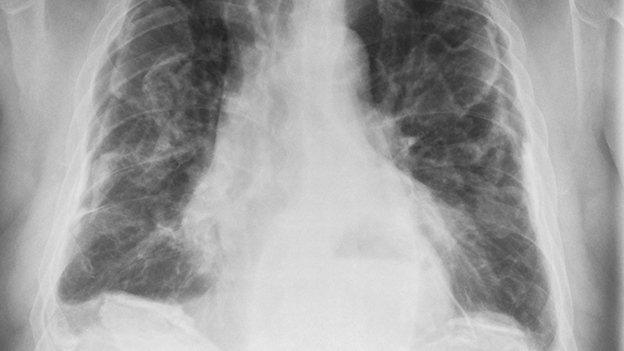 X-ray of lungs with cancer