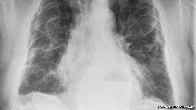 X-ray of lungs with cancer