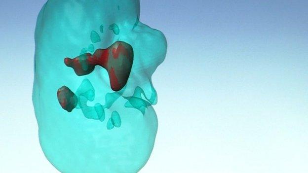 3D kidney scan