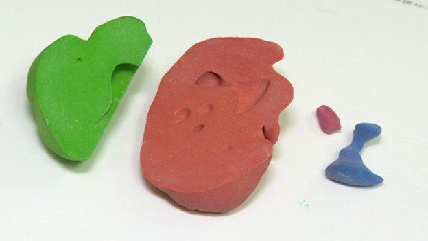 Model of kidney with kidney stone