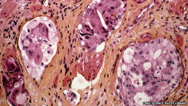 stomach cancer cells