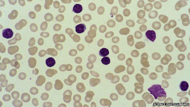 Acute lymphoblastic leukaemia