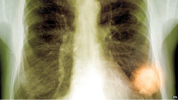 Chest x-ray showing a suspected tumour