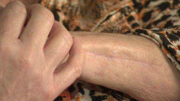 Scar on Melanie Watt's arm after a dog attack