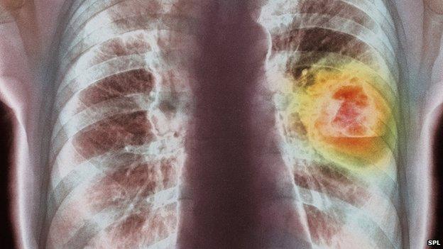 Lung scan showing cancer