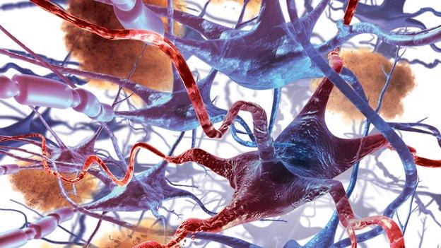 nerve cell death in Alzheimer's