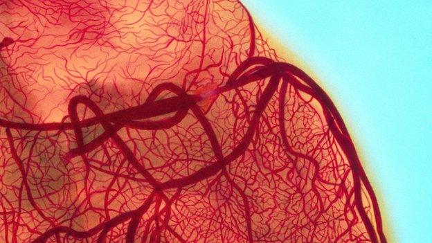 angiogram showing an obstructed coronary artery