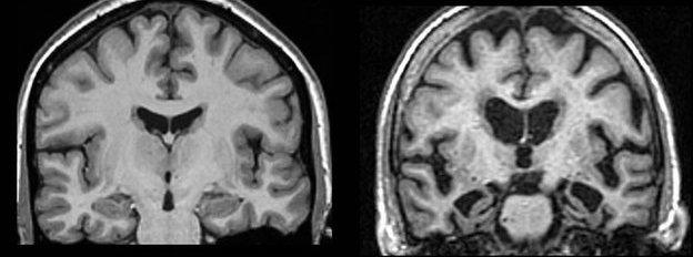 MRI brain scans