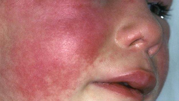 Scarlet fever on child's face
