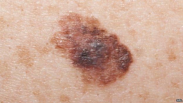 Melanoma