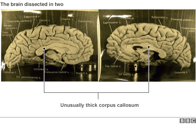 pictures of Einstein's brain