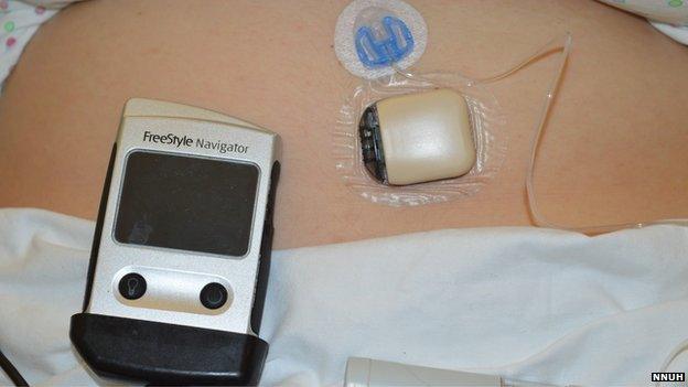 Artificial pancreas attached to a pregnant woman