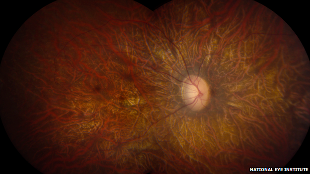 LCA affects the functioning of the retina, the light-sensitive tissue at the back of the eye