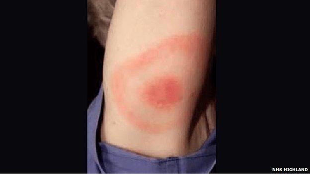 Tick bite