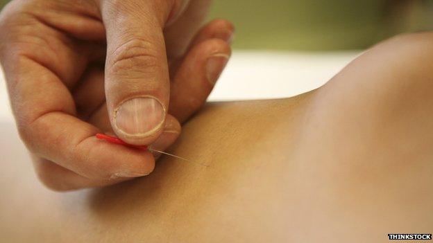 Acupuncture close-up