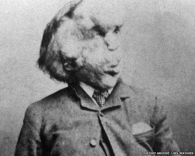 Joseph Merrick