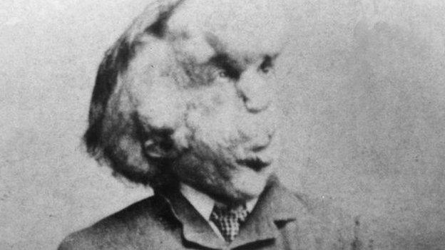 Joseph Merrick