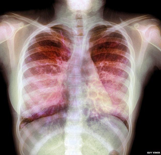 X-Ray of CF Patient