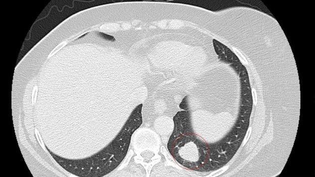 CT scan before treatment