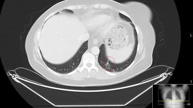 CT scan after treatment