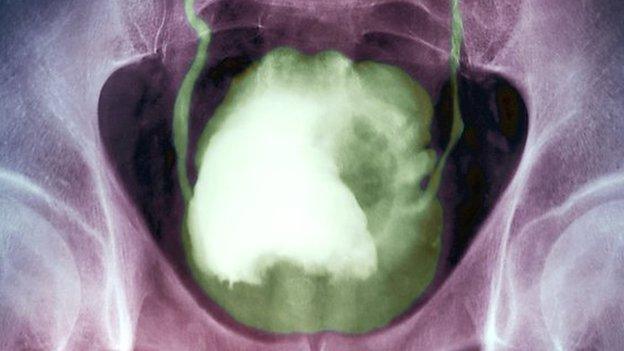 A cancerous bladder (the white area)