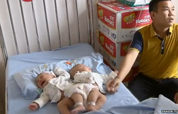 The babies before surgery in a hospital bed.